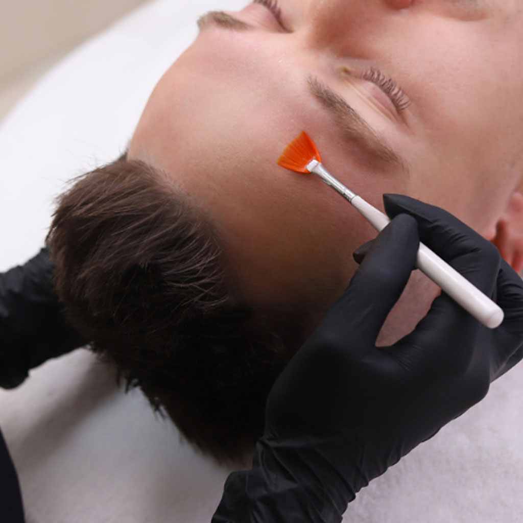 Chemical Peels